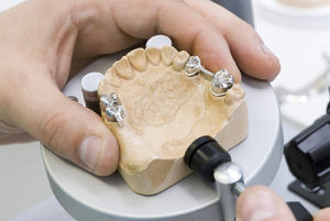 dental-bridge